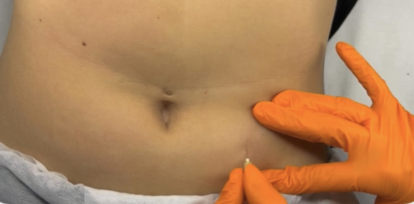Carboxytherapy online course – expanded treatment materials