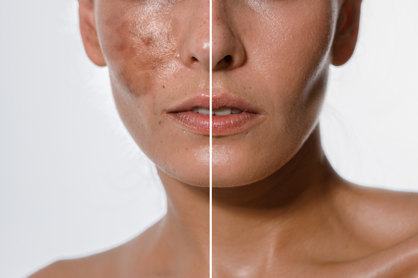 Discover How to Easily Apply Chemical Peels with Lesson 7 at Beauty Expert Online!