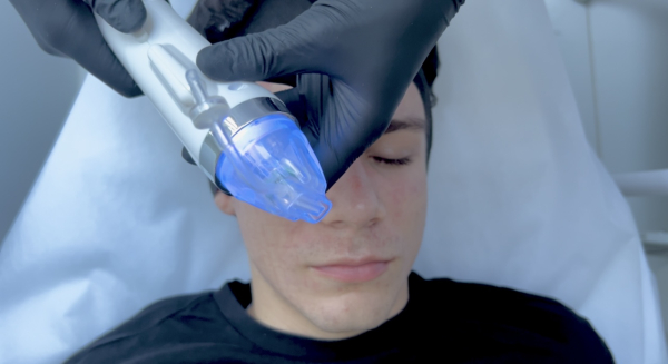 How Microneedling RF Transforms Skin Structure Through Dual Mechanical-Thermal Stimulation