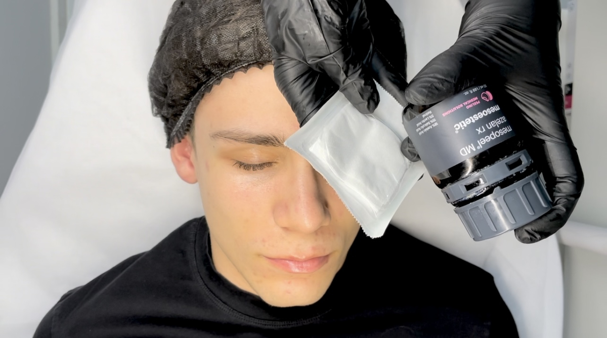 How Molecular Size Shapes the Depth and Effectiveness of Chemical Peels