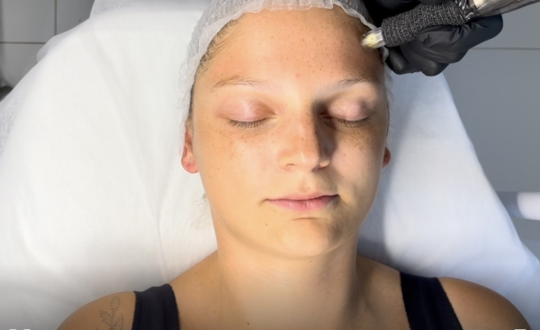 Kurs Online Mezoterapia Mikroigłowa – aktualizacja