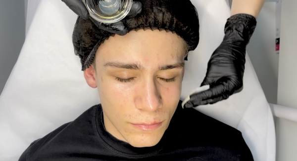 Kurs Peelingi chemiczne – aktualizacja