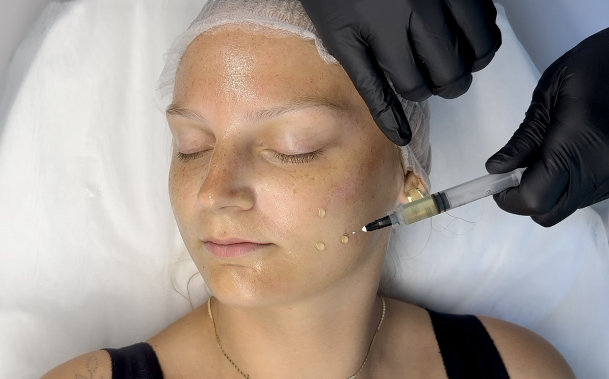 Microneedling mesotherapy course – new PRX-T33 combination therapy