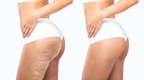 Cellulite Analysis Online Course