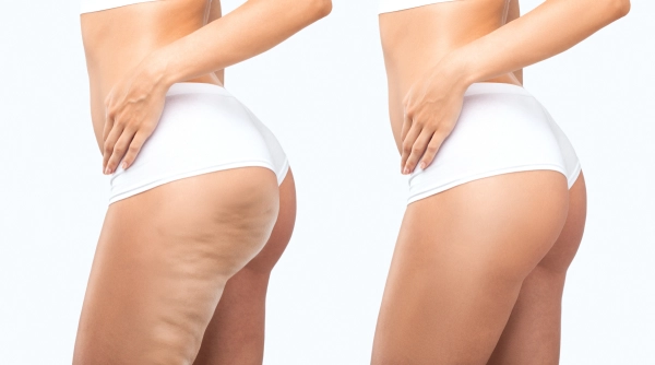 Cellulite Analysis & Treatment Online Course