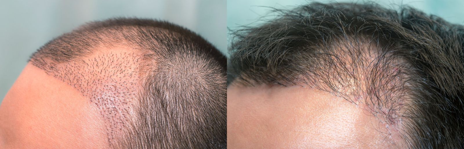 Trichology course – scalp diagnostics, hair loss types, and professional scalp care techniques.