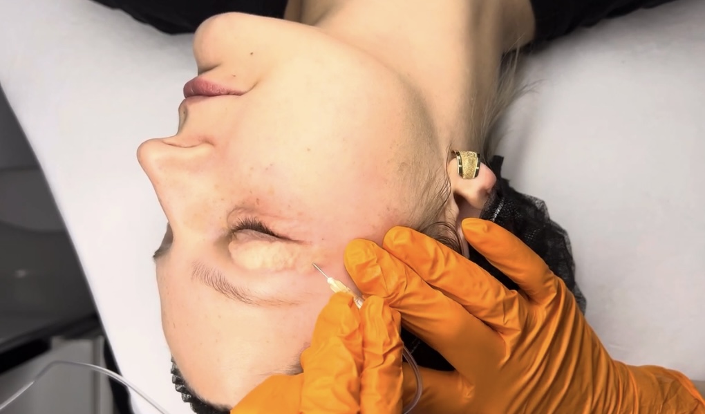 Carboxytherapy course – targeted CO₂ injection to enhance microcirculation and skin firmness.