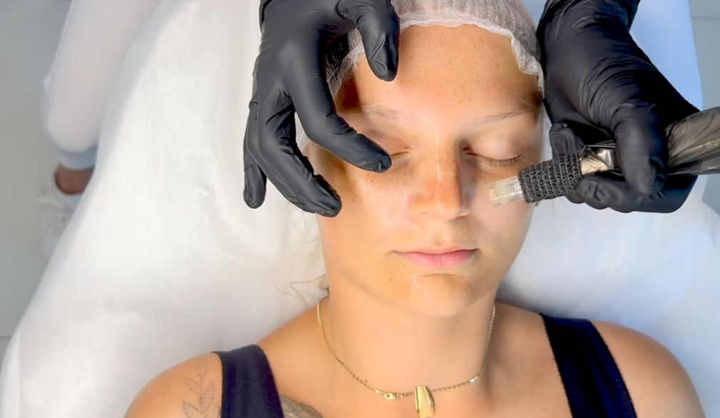 PRX-T33 with microneedling course – product composition, application technique, and skin biorevitalization.