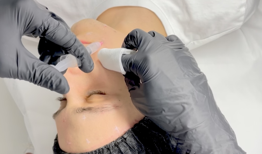 Collagen mesotherapy course – types of collagen, product formulas, and injection technique in skin rejuvenation.