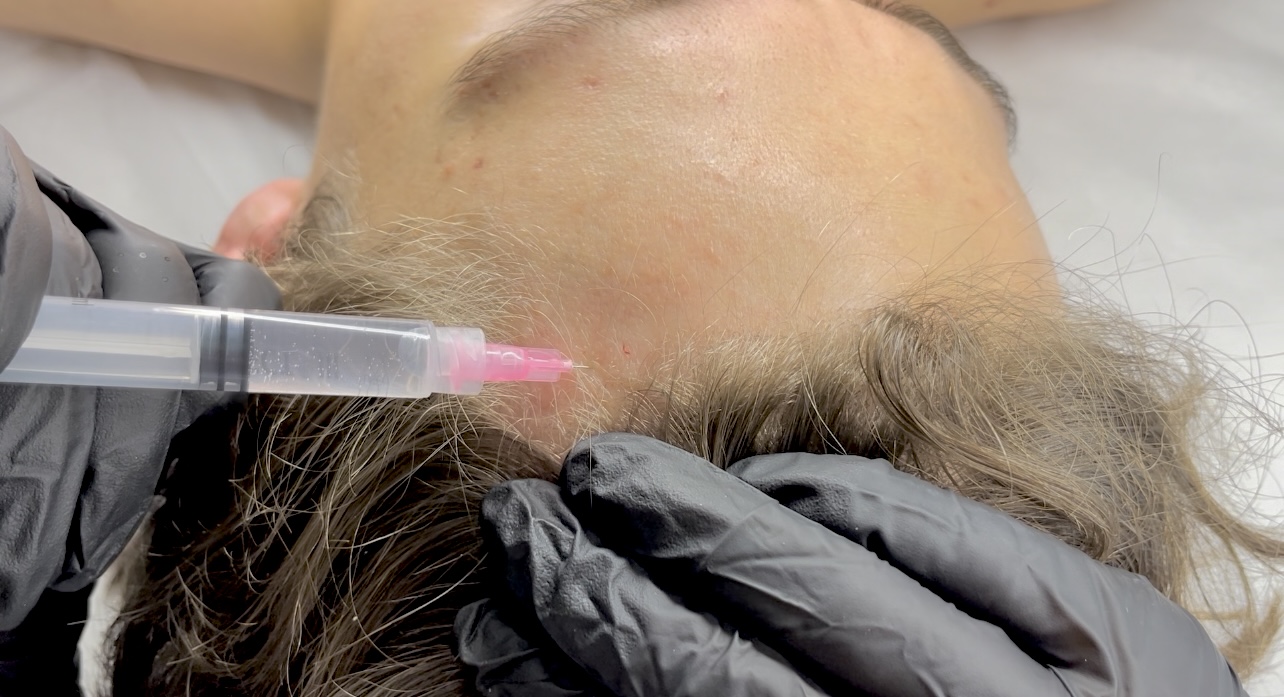 Step-by-step trichological mesotherapy – application of scalp stimulators and mesotherapy products during a practical lesson in the one-year beauty school program