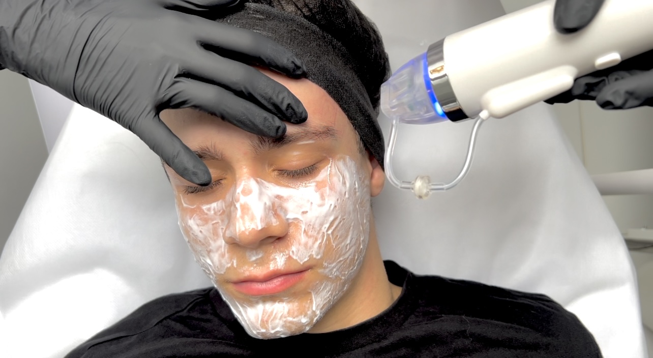 RF microneedling &ndash; combining microneedles and radiofrequency energy for skin stimulation and tissue remodeling