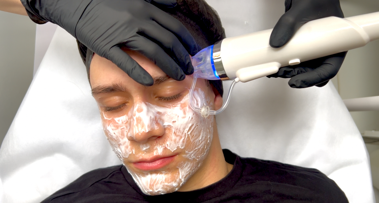 RF microneedling training demonstrating device operation and the treatment procedure step by step.