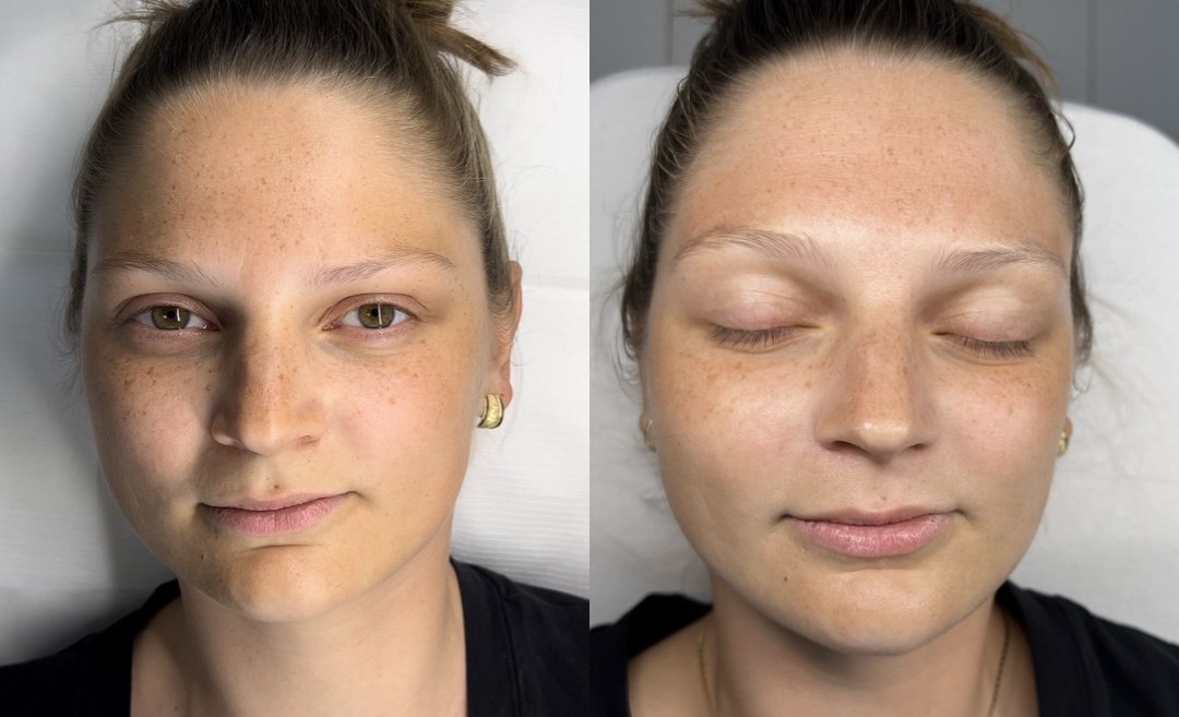 BB Glow treatment with brightening cocktail – microneedling and skin tone improvement during a one-year beauty school lesson.