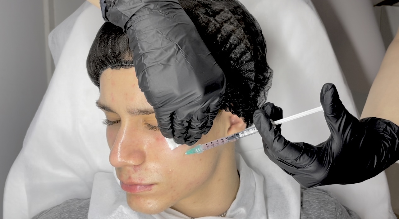 Hybrid mesotherapy course – combining microneedling and needle injection with Pink Glow peptide formula.