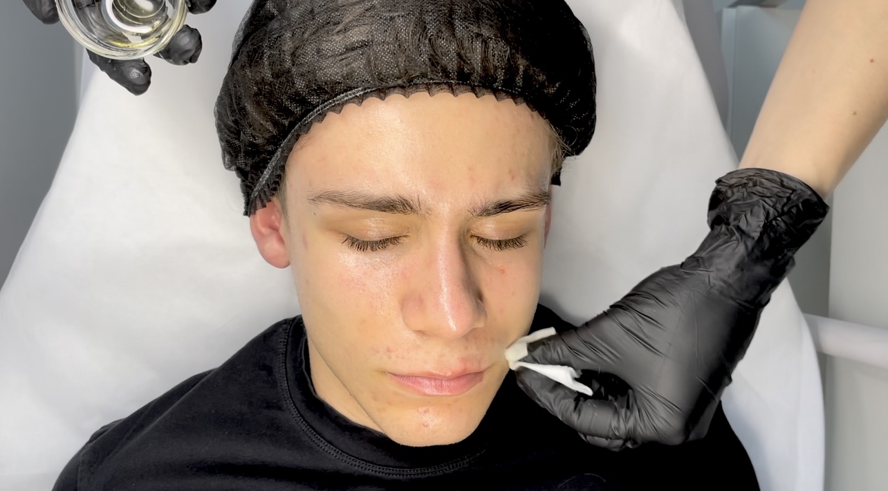 Diagram showing molecular size differences in chemical peels