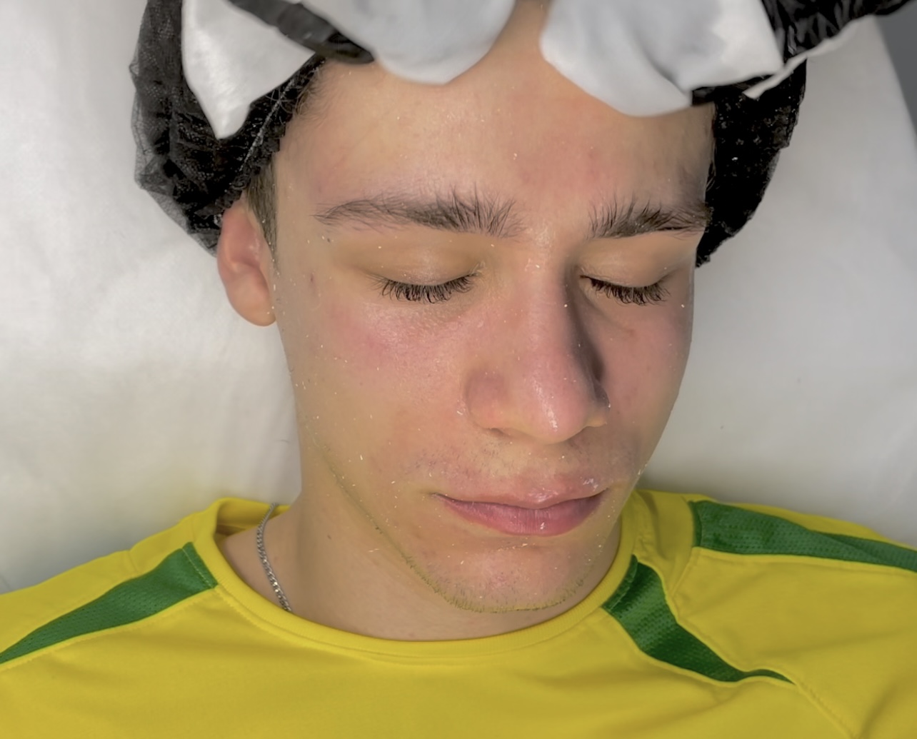 Advanced manual extraction using salicylic acid – step-by-step procedure demonstrated during a lesson in the one-year beauty school program, including treatment protocol for problematic skin.