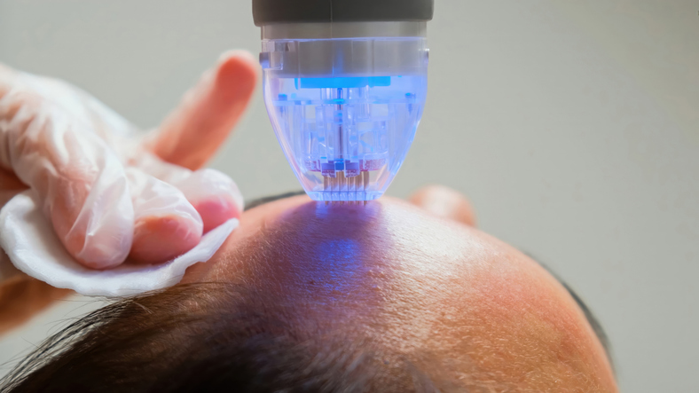 Microneedling RF device delivering thermal energy into the dermis during treatment