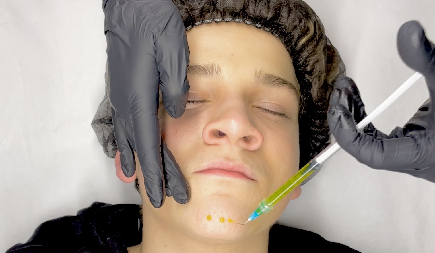 BioRePeel course – advanced biostimulating chemical peel for skin renewal and revitalization.